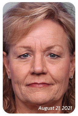 OPENEYES Awaken Peptide Lifting Eye Gel - Buy 1 Get 1 FREE