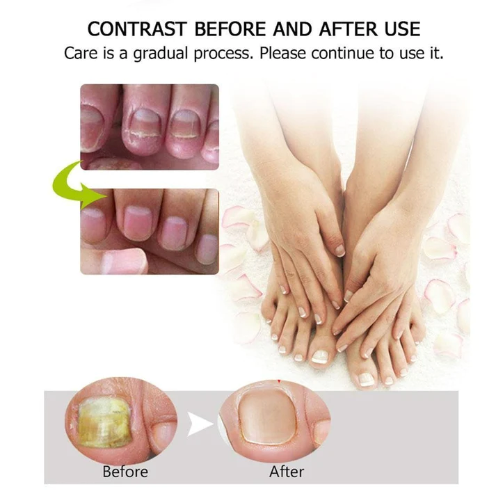 BROWSLUV™ Anti-Fungal Nail Repair Gel | Buy 1 Get 1 FREE