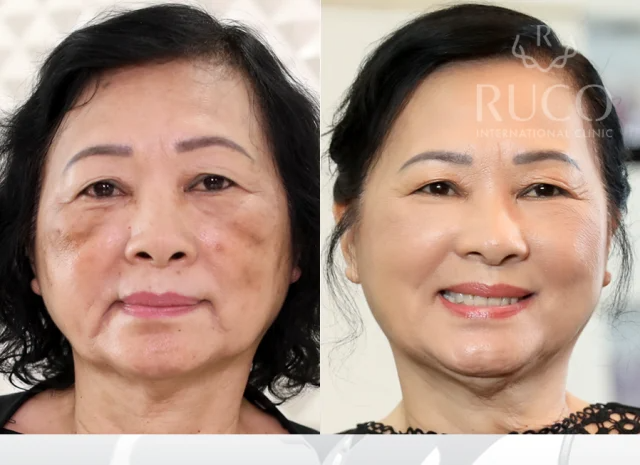 BROWSLUV™ SKIN WHITENING EXFOLIATING GEL | Buy 1 Get 1 Free